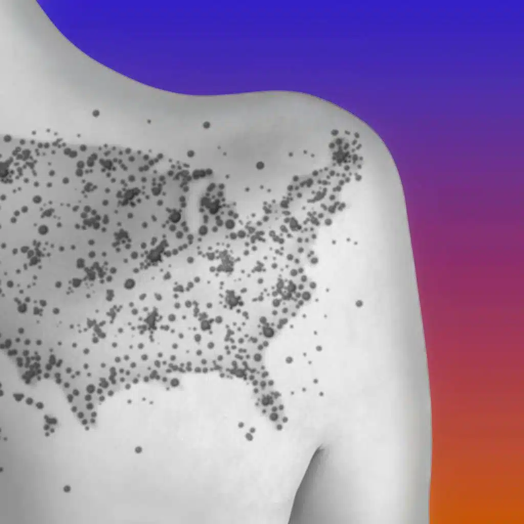 Hot Measles Summer