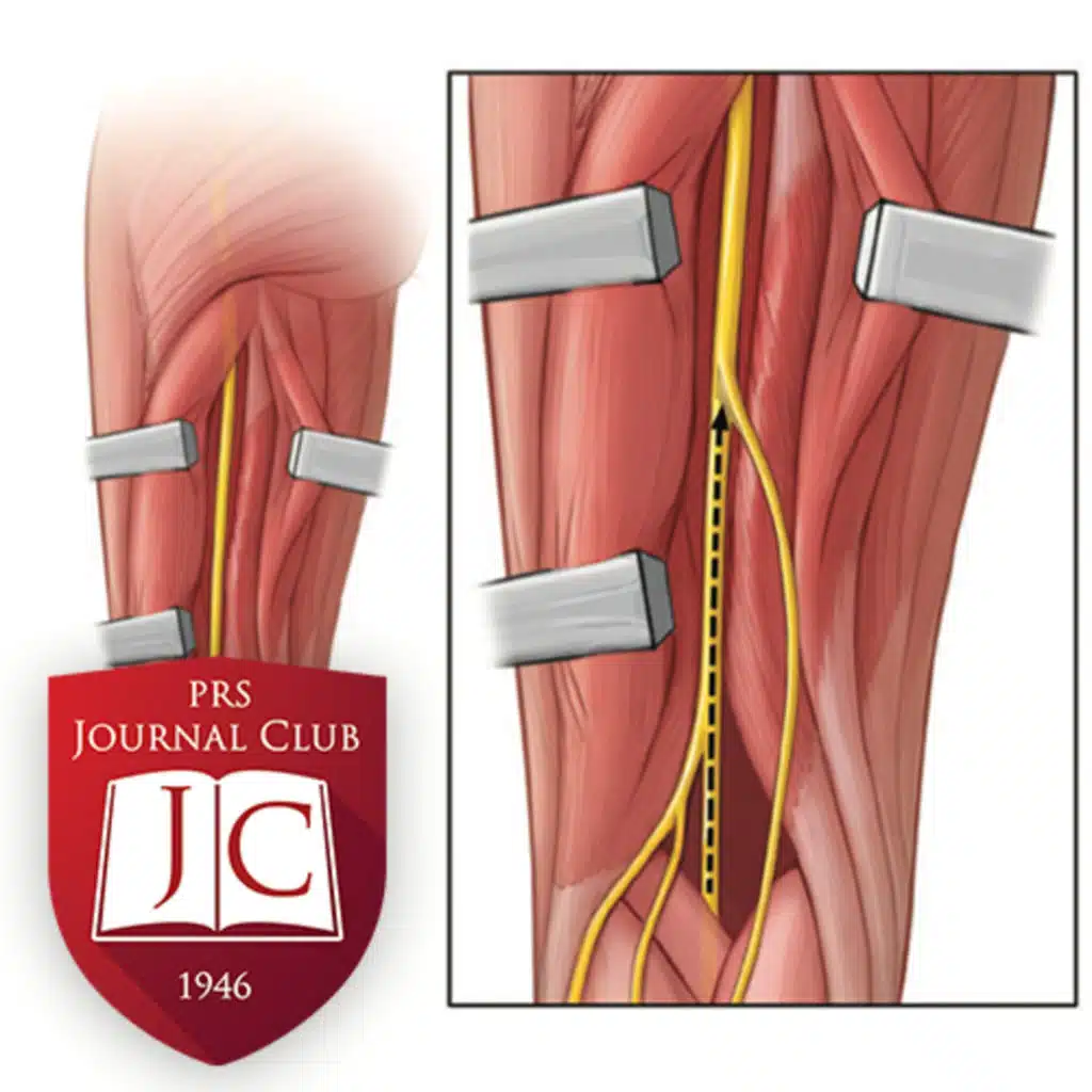 "Extended Sural Nerve Harvest" with Shai Rozen, MD - Jan. 2026 Journal Club