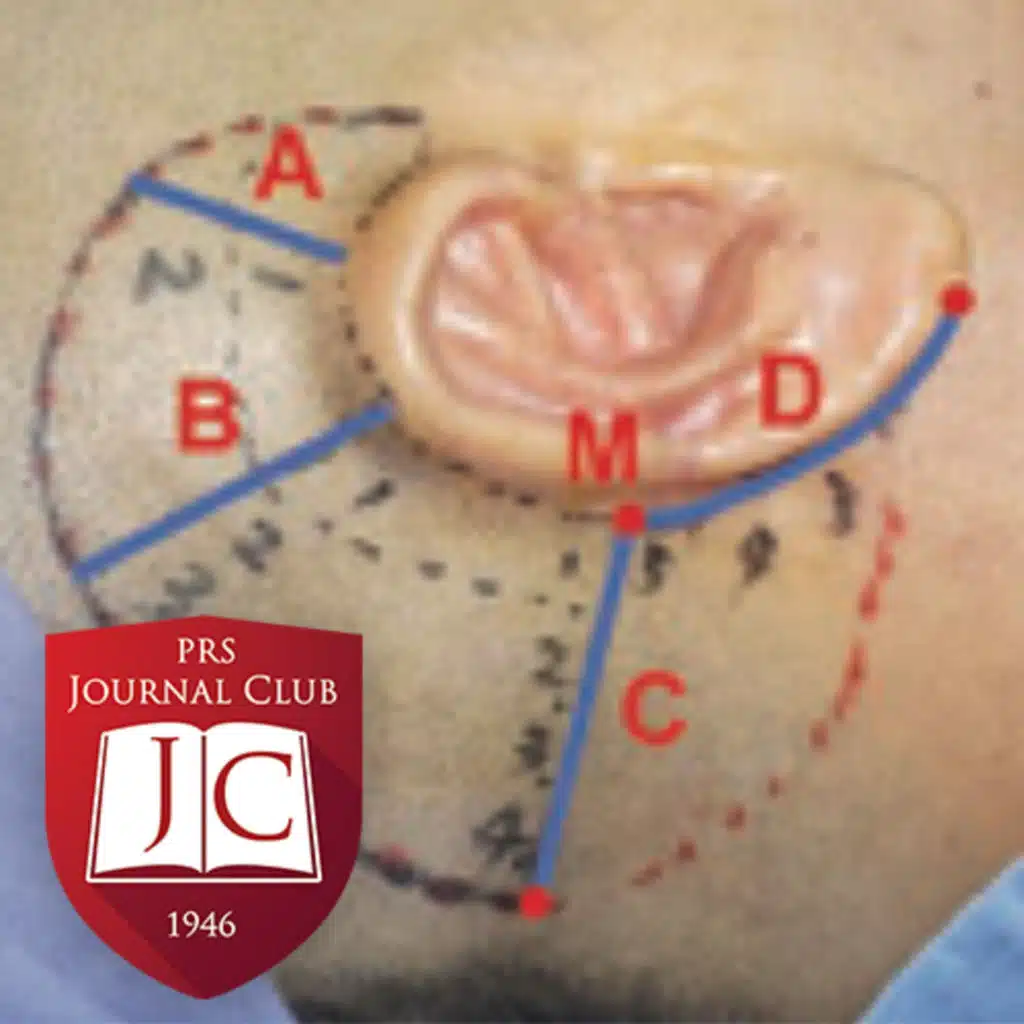 "Ear Elevation in Auricular Reconstruction" with Scott P. Bartlett, MD - Feb. 2026 Journal Club