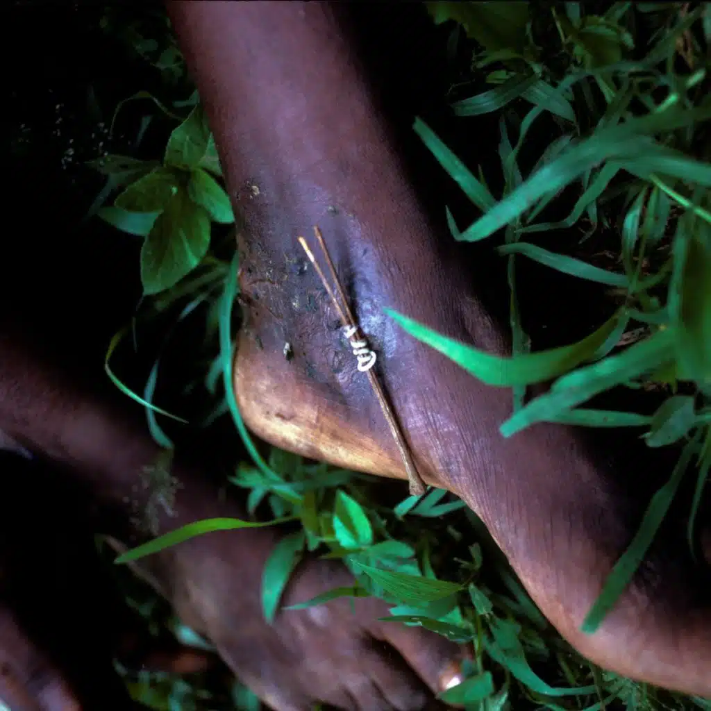 Can we eradicate a second human disease?