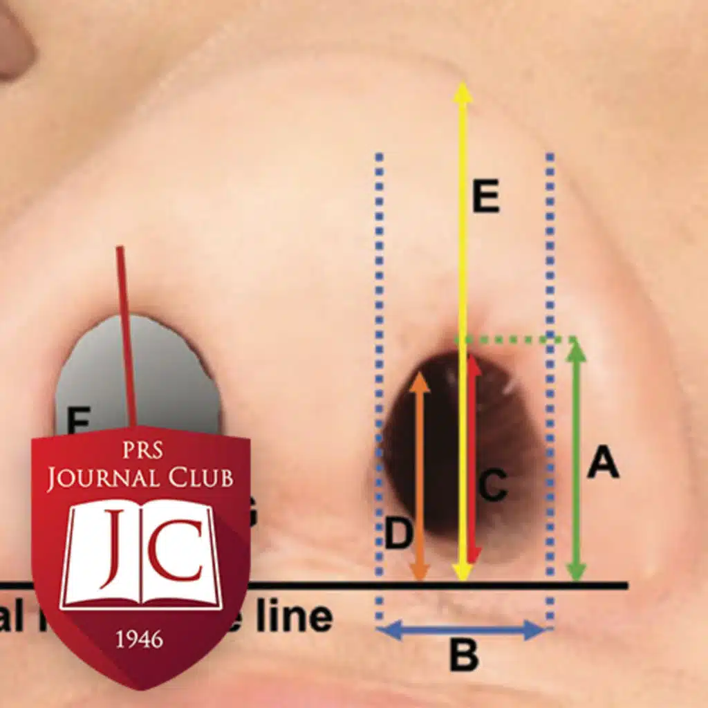 "Unilateral Cleft Nose Repair" with Jordan Swanson, MD, MSc - Apr. 2026 Journal Club