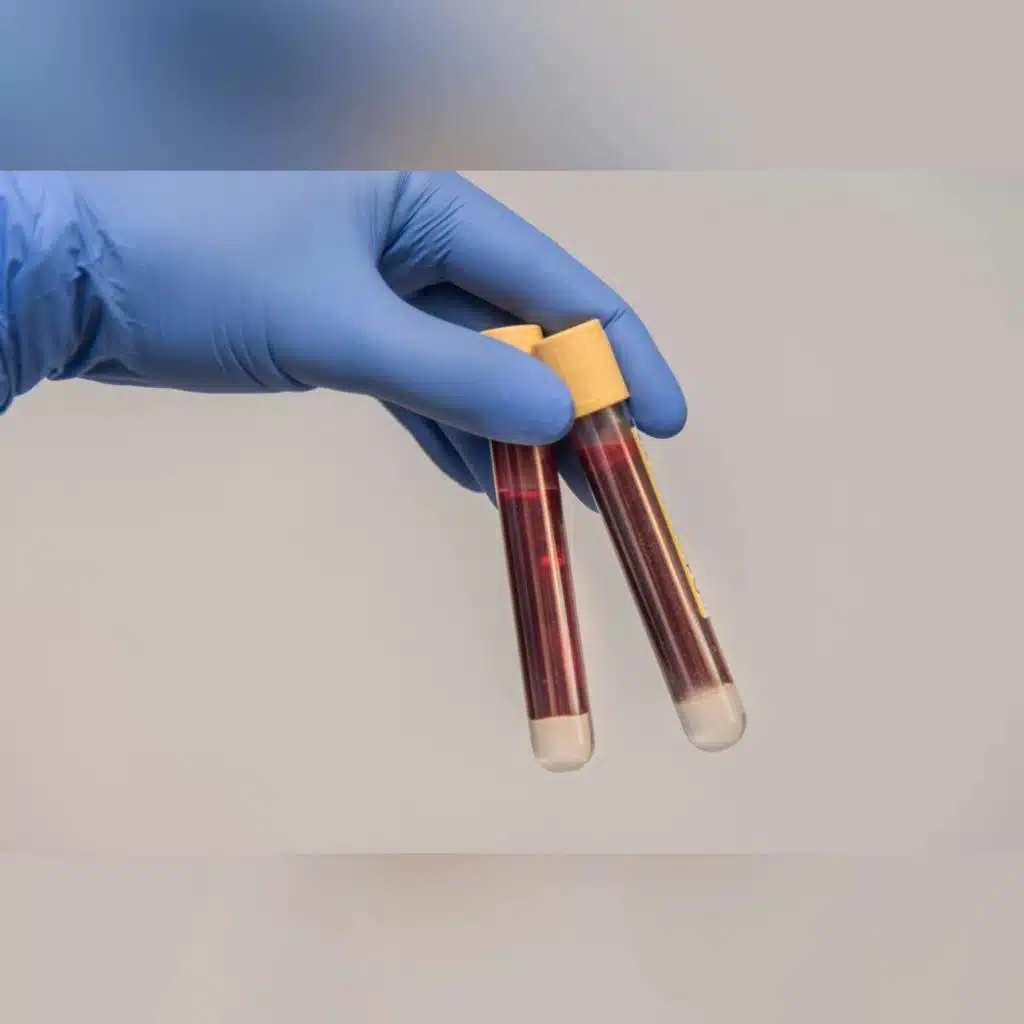 Ask the Expert: Blood Donation