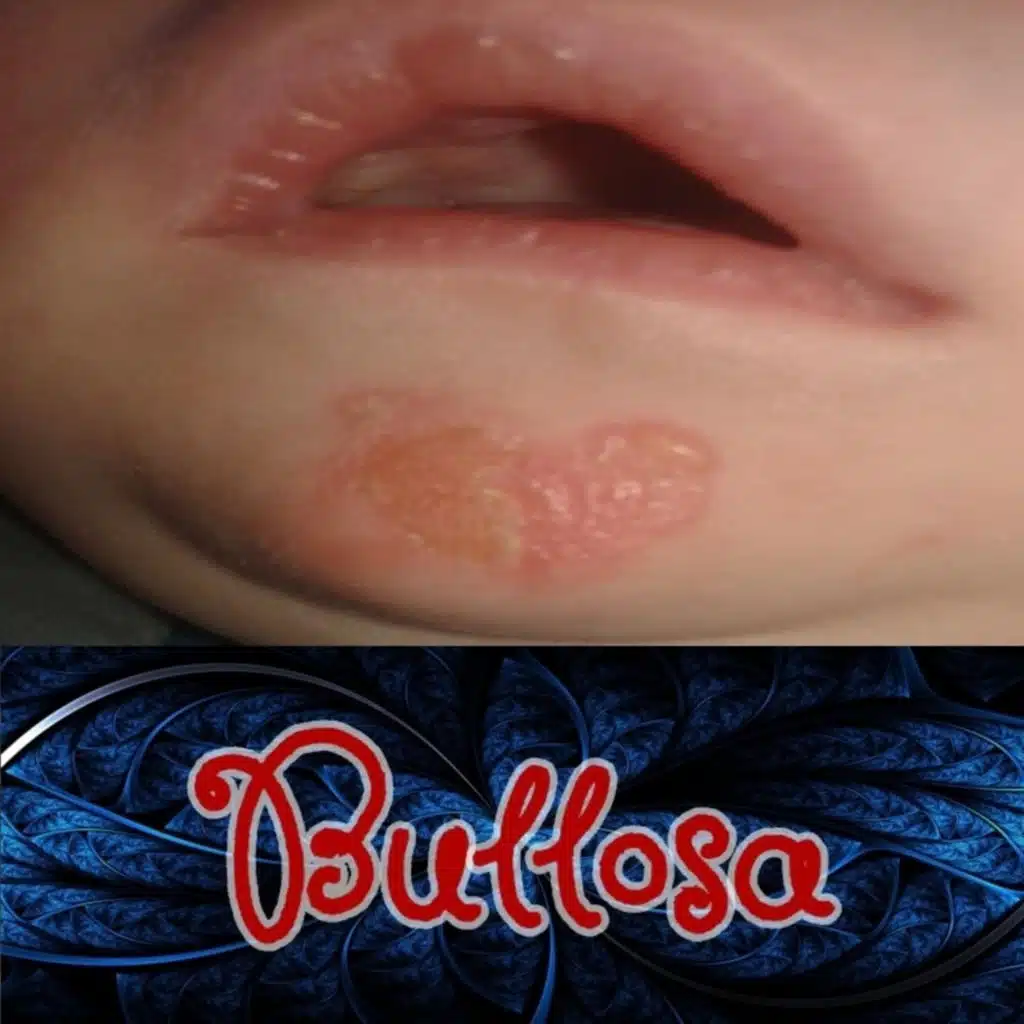 Blistering Heart