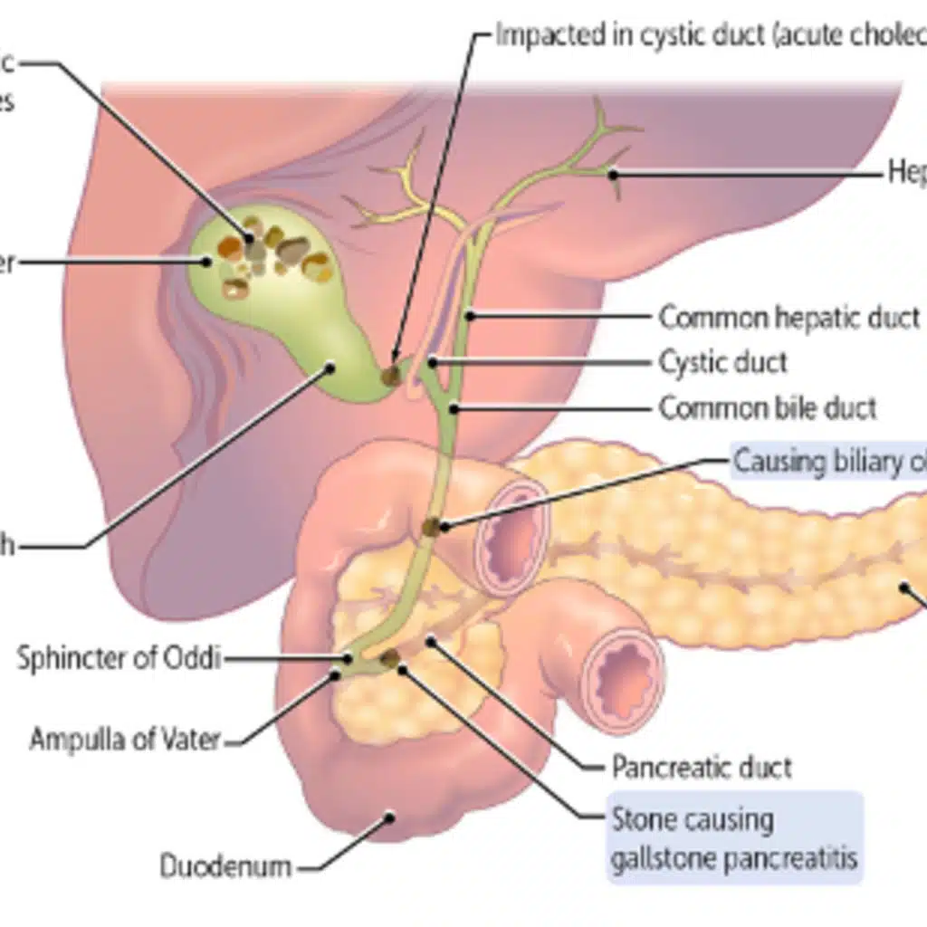 Essentials – Cholelithiasis and Cholecystitis
