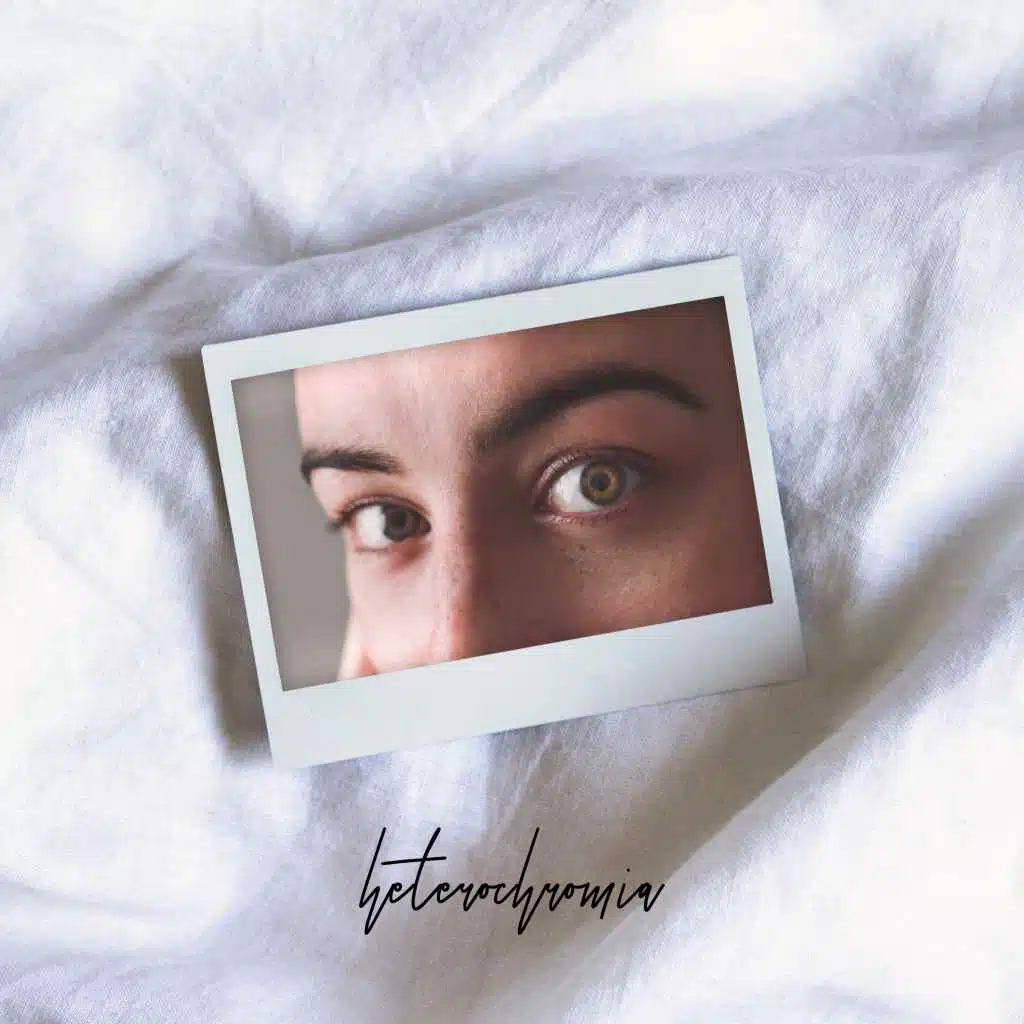 Heterochromia